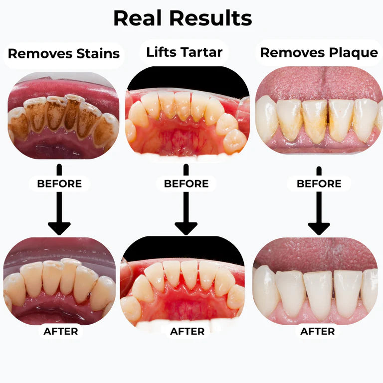 TandStensBorttagaren™