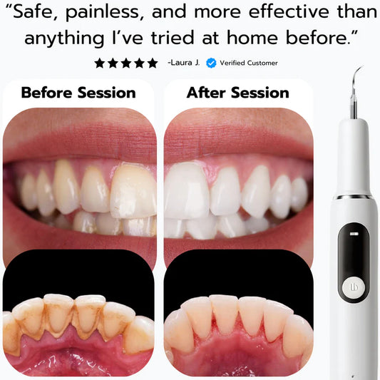 TandStensBorttagaren™